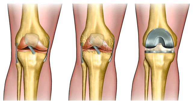 Ендопротезування колінного суглобу