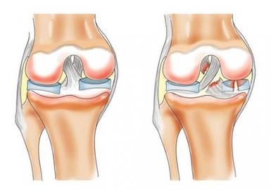 Операция на мениске коленного сустава 