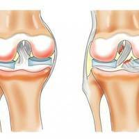 Операция на мениске коленного сустава 