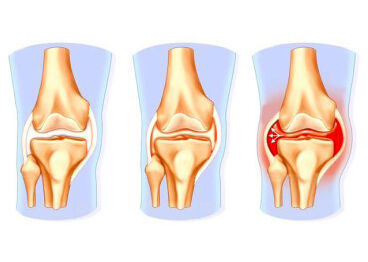 Операція на меніску колінного суглоба