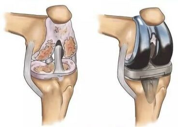 Операція колінного суглоба