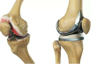 Профілактика артрозу колінних суглобів