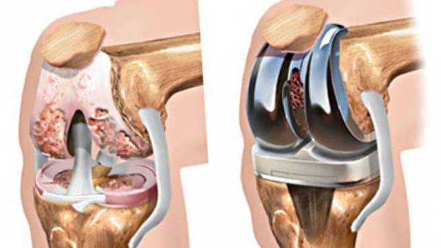 Лікування асептичного некрозу кістки колінного суглоба