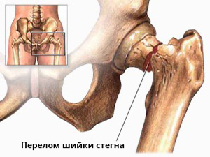 Операція при переломі шийки стегна