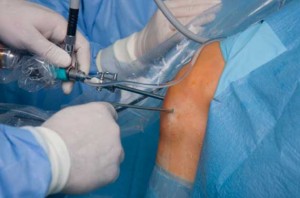Процес проведення операції на колінному суглобі