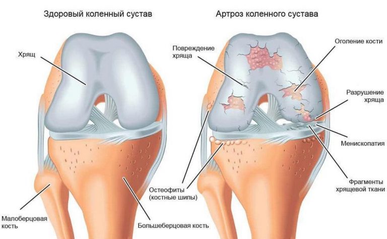 Деформуючий артроз колінного суглоба
