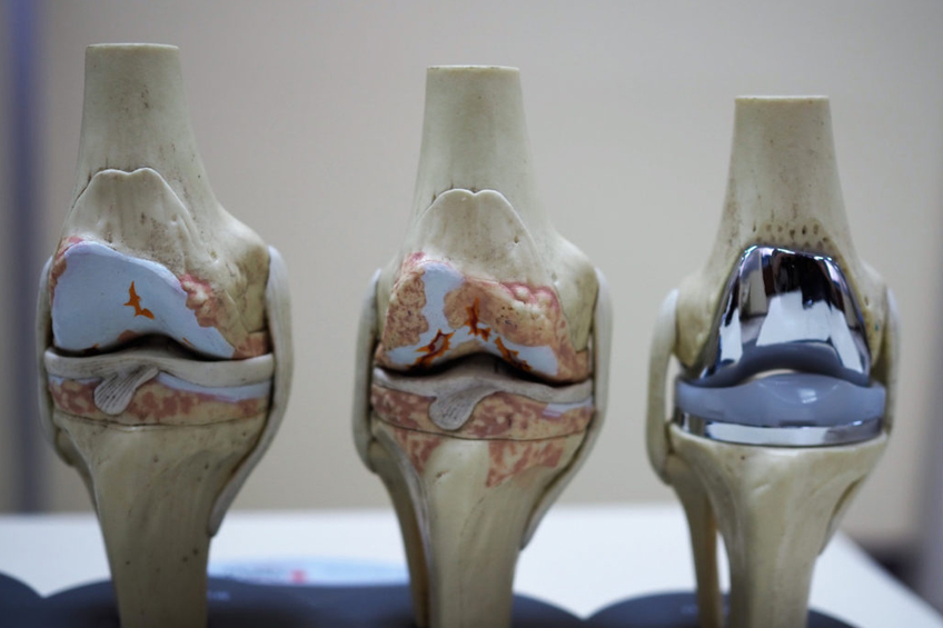 Замена коленного сустава после артроза