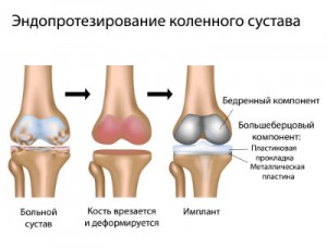 Процесс эндопротезирование коленного сустава