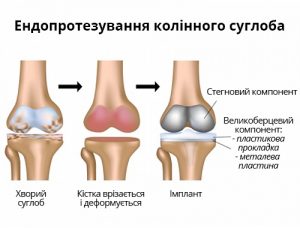 Ендопротезування колінного суглобу