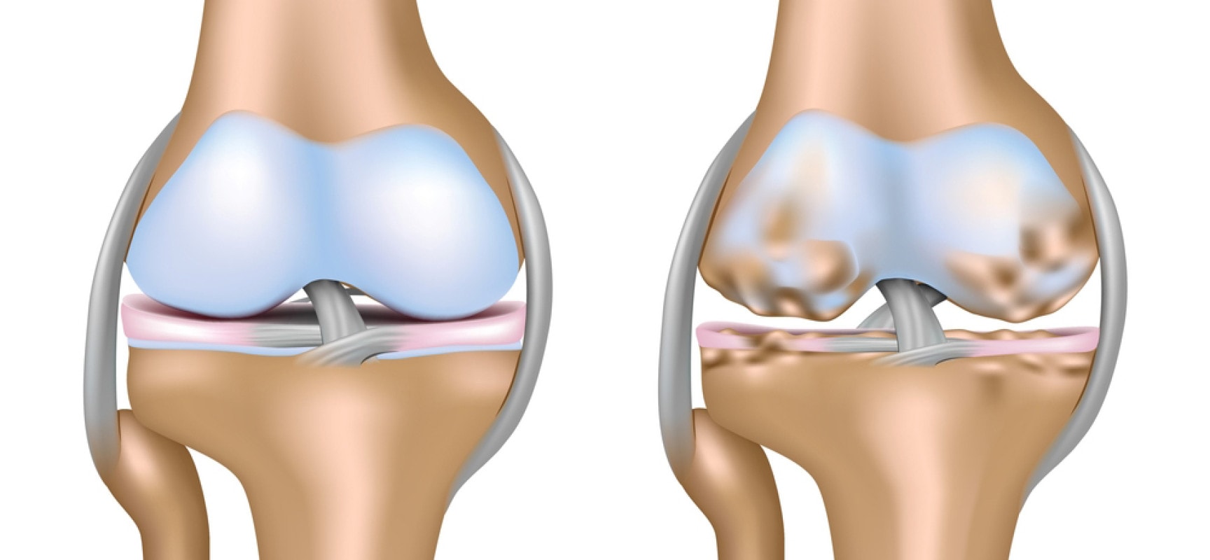 артроз колінних суглобів