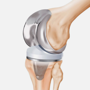 Эндопротез коленного сустав