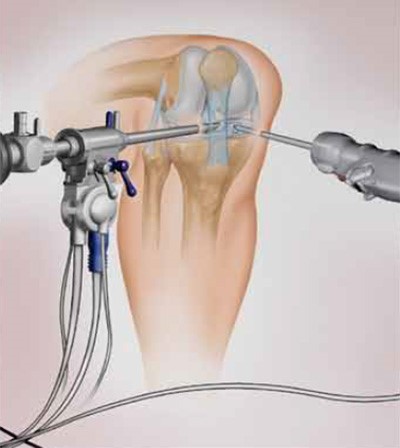 Схема операції на меніску колінного суглоба	